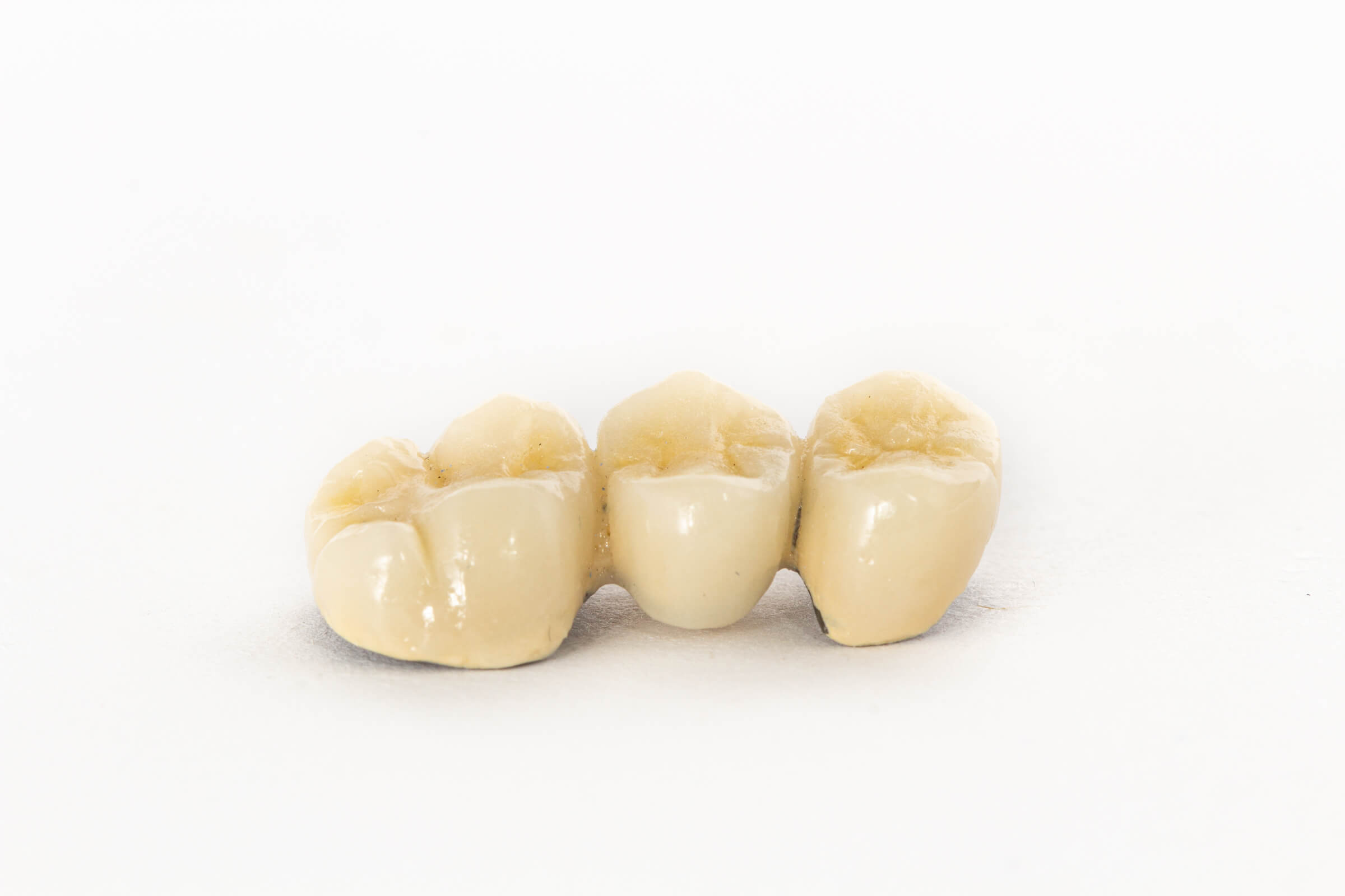 Corona dental de metal (níquel-cromo) –