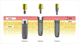 implantes