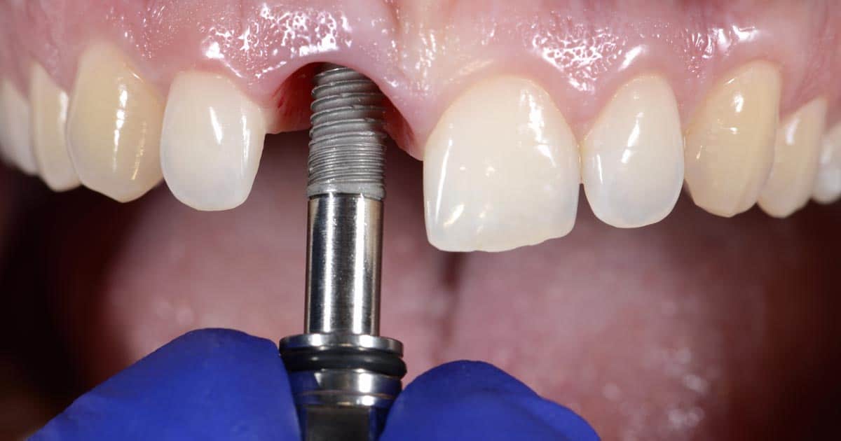 ¿Qué son los implantes dentales?