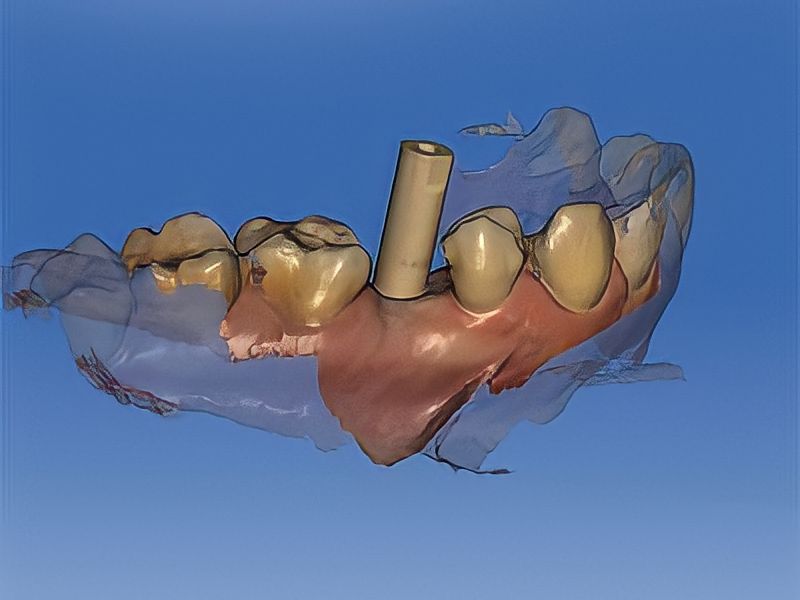 escáner intraoral