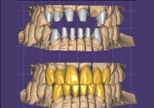 escaner intraoral