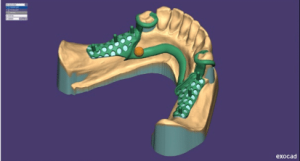 removibles con impresoras 3d