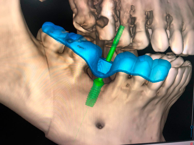 La Integración de Guías Quirúrgicas y Estudios Digitales en la Colocación de Implantes Dentales